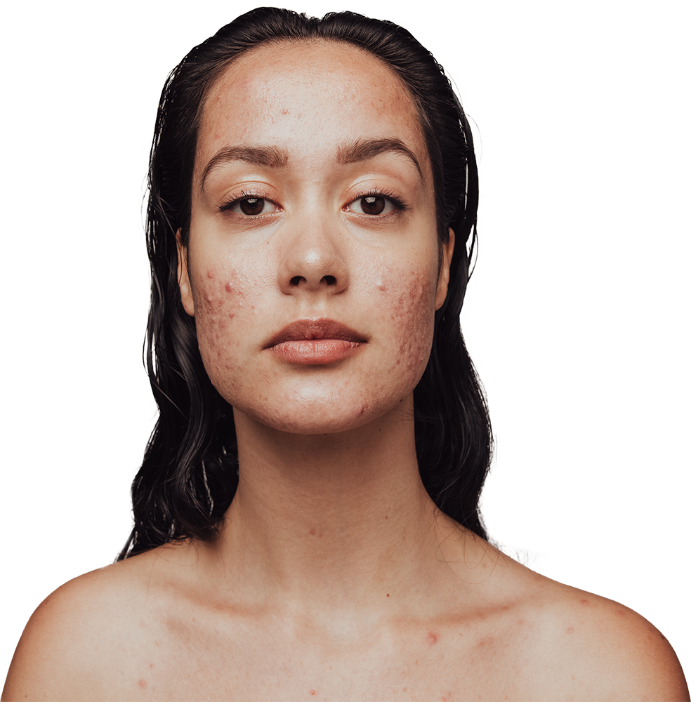 Woman with acne